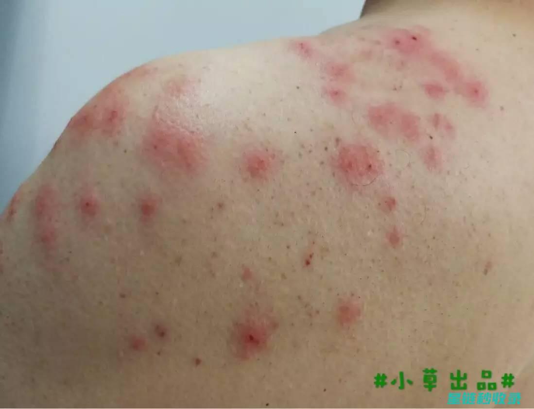 蚊虫叮咬后的止痒方法，你get到几招？ (蚊虫叮咬后的图片)